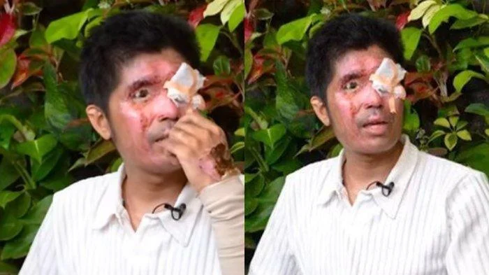 Korban Air Keras: Andrie Yunus Jalani Operasi Mata Berulang